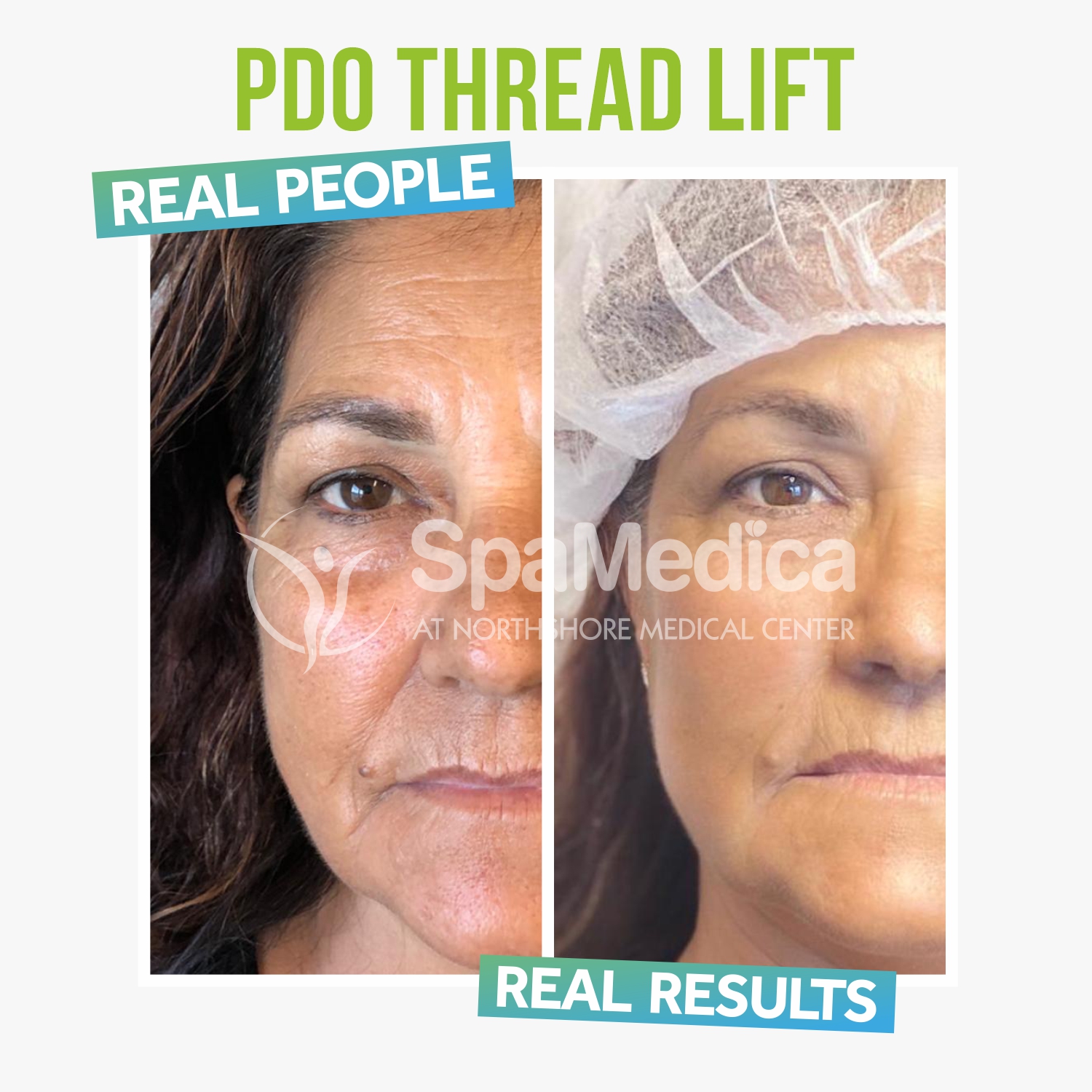 PDO Threads  Bucks County, PA - La Chelé Medical Aesthetics